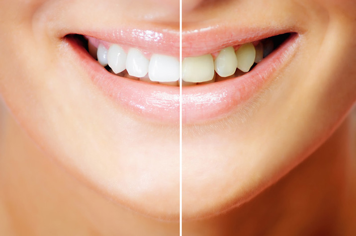 Teeth Whitening Offered by Dentist in Simi Valley