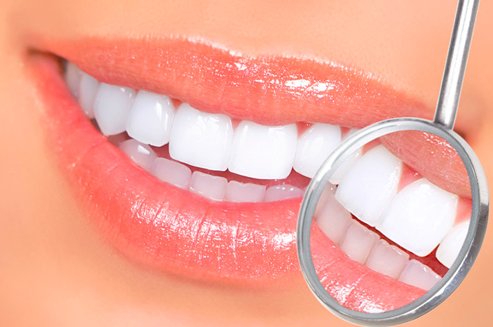 Can I Have Teeth Whitening If I Have Crowns, Veneers, or Implants?