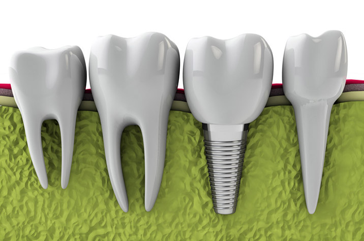 Dental Implants in Simi Valley Can Boost Your Oral and Overall Health