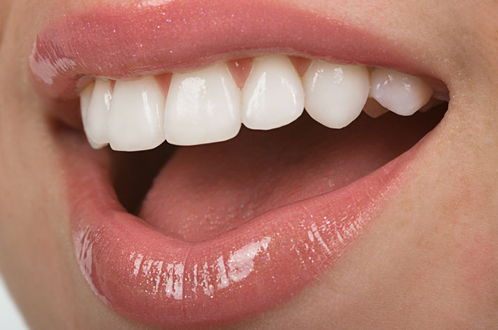 Am I a candidate for veneers?