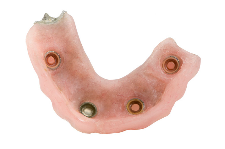Using Implants with Dentures for an Amazing Smile Restoration