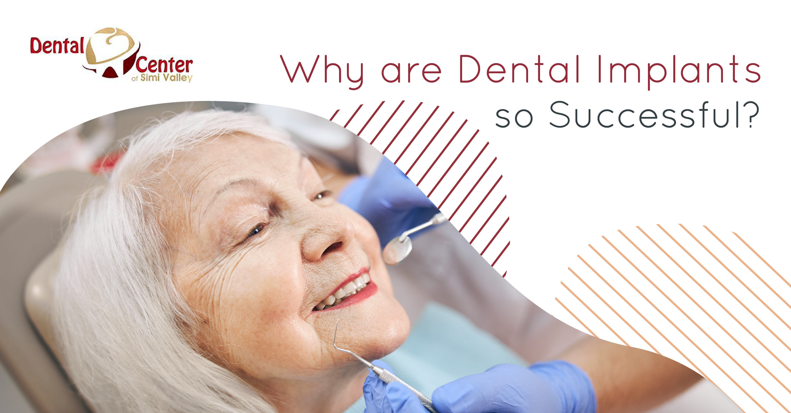 Six Reasons Why Dental Implants Are So Popular