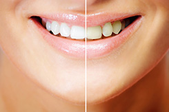 Brighten Your Smile with Teeth Whitening Offered by Dentist in Simi Valley