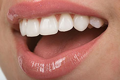 Am I a Candidate for Veneers?