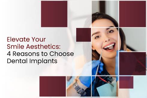 Elevate Your Smile Aesthetics: 4 Reasons to Choose Dental Implants