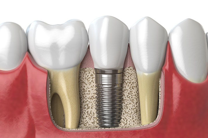 Does Dental Insurance Cover Implants?