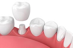 The ABC of dental implants